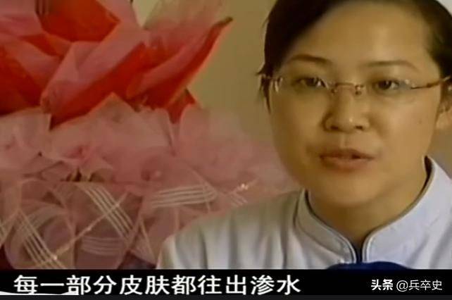 猫叫综合症成因
