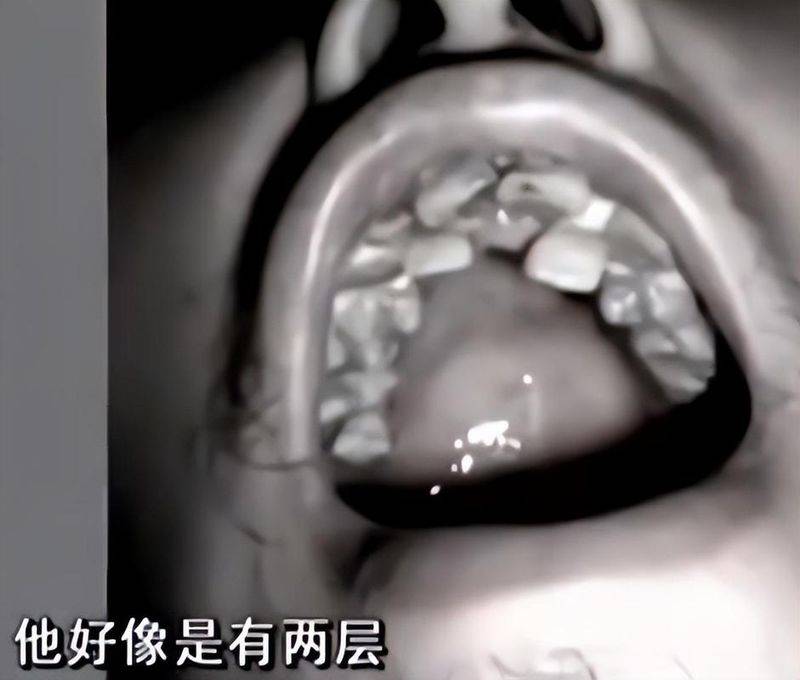 猫叫综合症成因