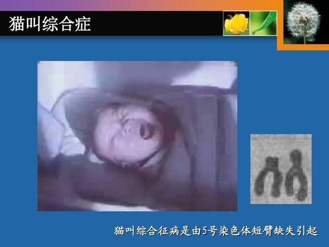 猫叫综合症成因