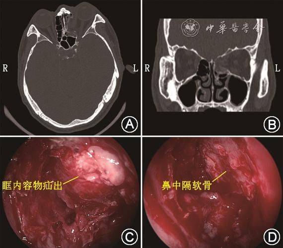 斜视手术多少钱