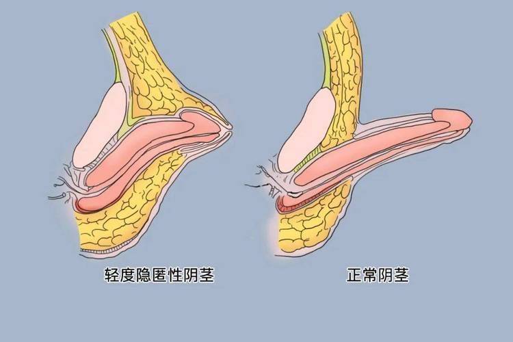 武汉割包皮手术多少钱
