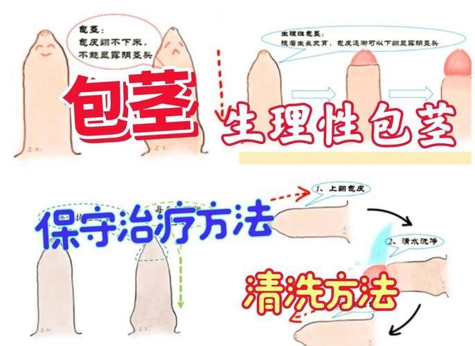 武汉割包皮手术多少钱