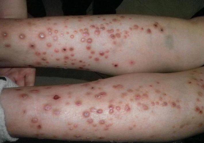 An allergy