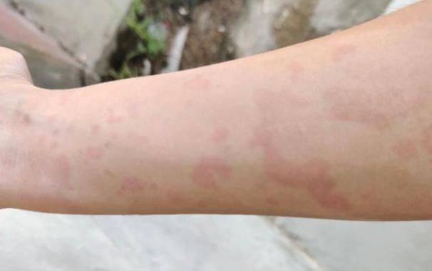 An allergy