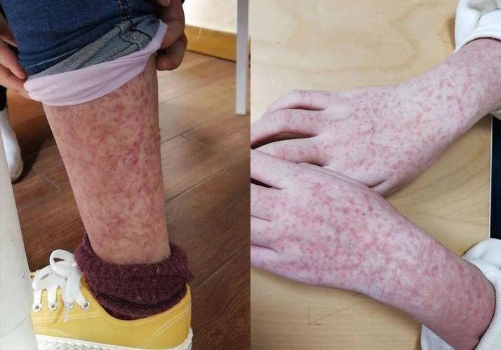 An allergy