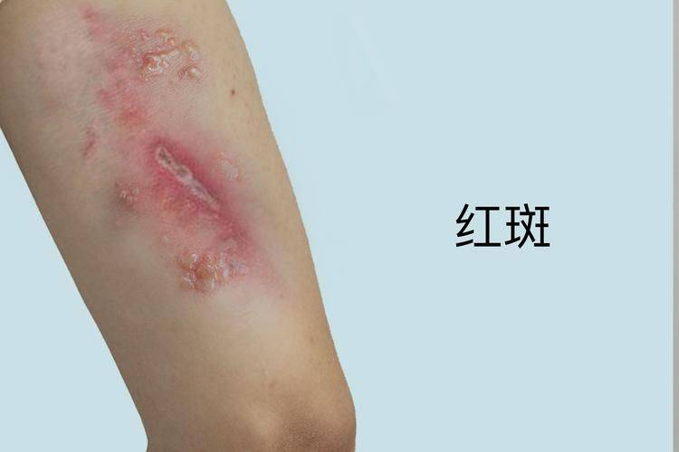 An allergy
