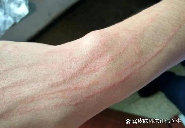 An allergy