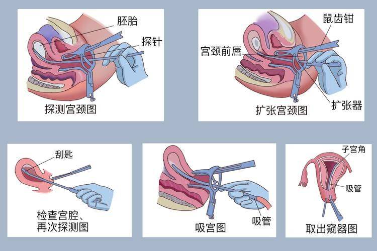 How much is ankang without pain