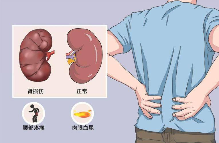 How much can kidney syndrome be cured? Money