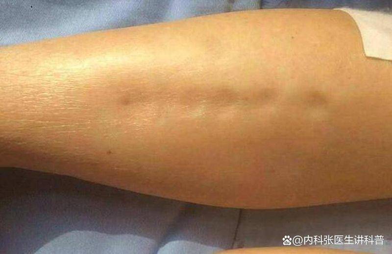 How much can kidney syndrome be cured? Money