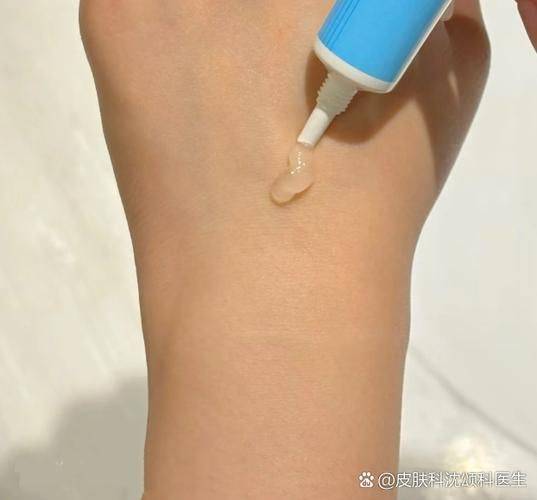 去除痘印的方法