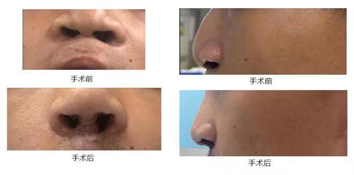How much for a narrow nose