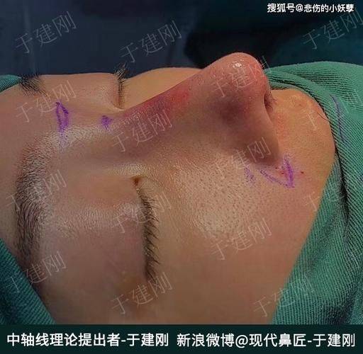 How much for a narrow nose
