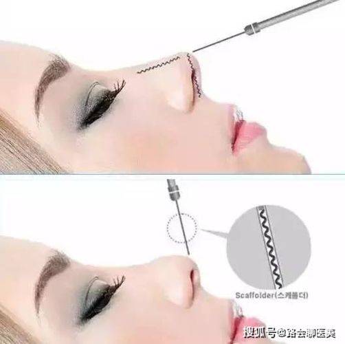 How much for a narrow nose
