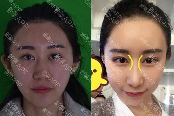 How much for a narrow nose