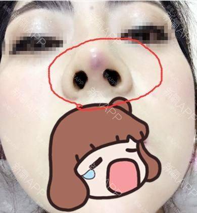 How much for a narrow nose