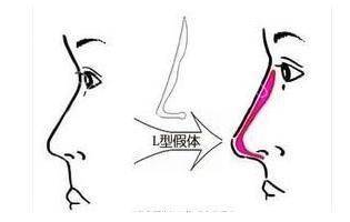 How much for a narrow nose
