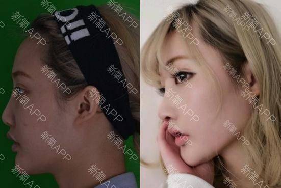 How much for a narrow nose
