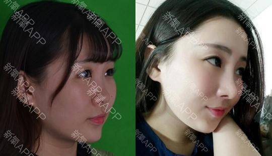 How much for a narrow nose