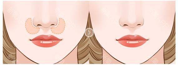 How much for a narrow nose