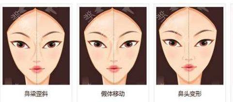 How much for a narrow nose