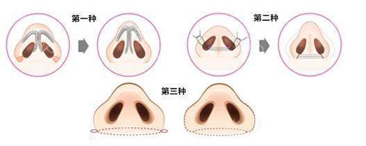 How much for a narrow nose