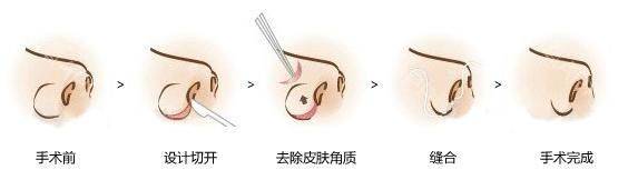 How much for a narrow nose