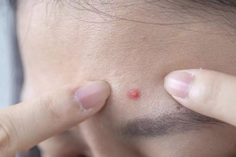 去除痘印的方法