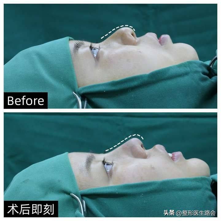 How much for a narrow nose