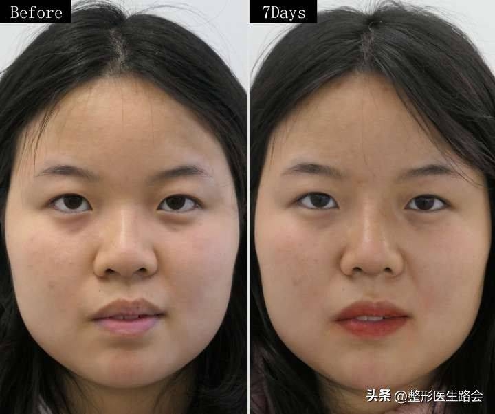 How much for a narrow nose