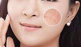How much is a laser wrinkle