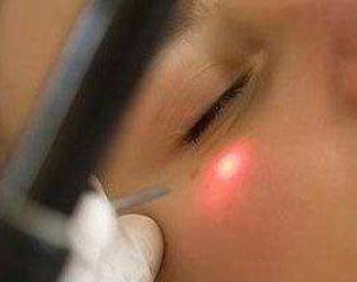 How much is a laser wrinkle