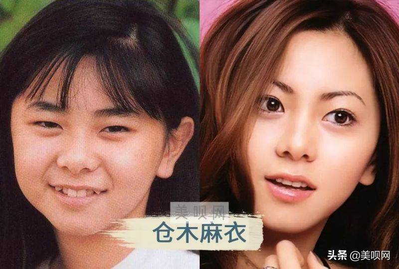 日本割双眼皮多少钱