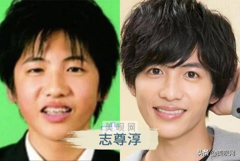 日本割双眼皮多少钱
