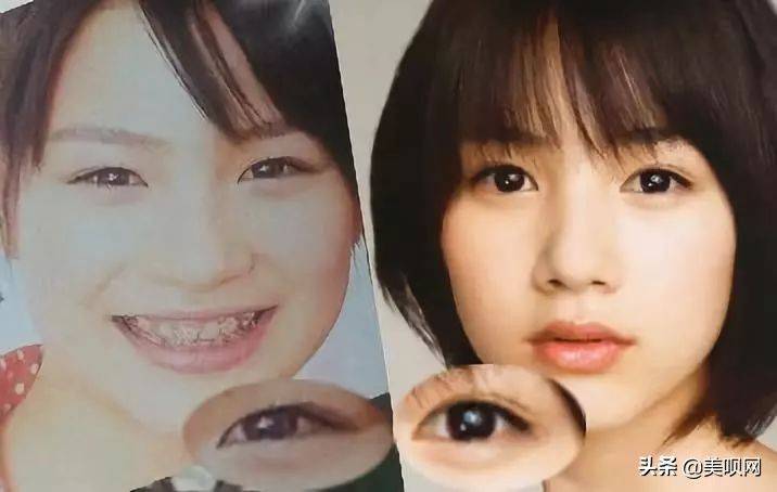 日本割双眼皮多少钱