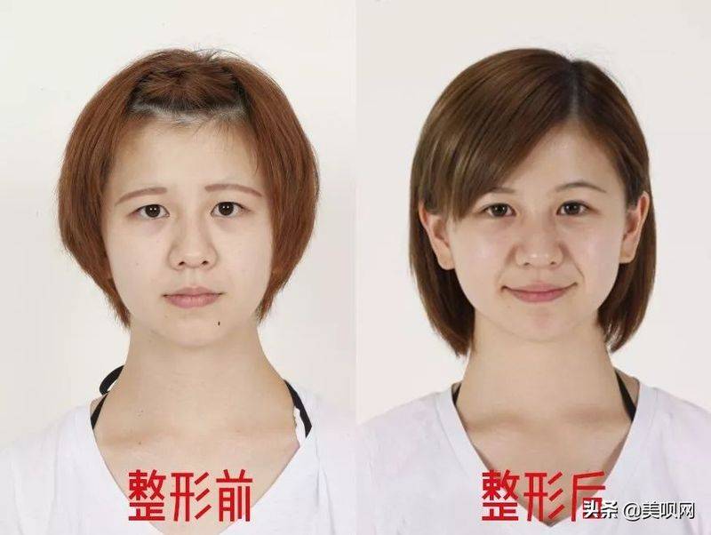 日本割双眼皮多少钱