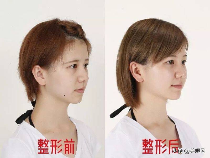 日本割双眼皮多少钱