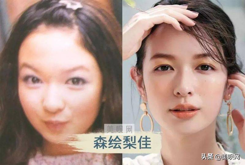日本割双眼皮多少钱