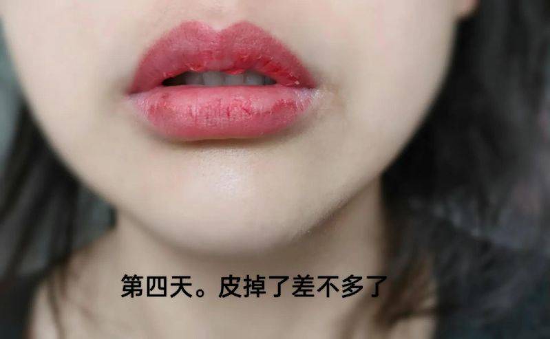 丰唇多少钱
