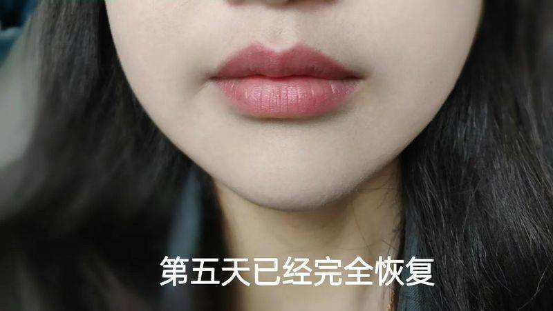 丰唇多少钱