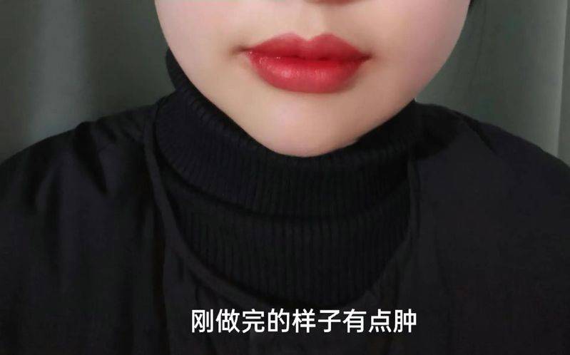 丰唇多少钱