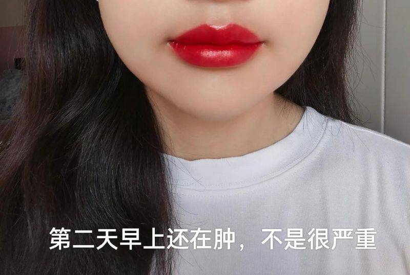 丰唇多少钱