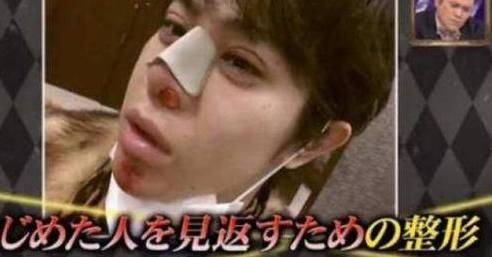 How much is japan's eyelid cut