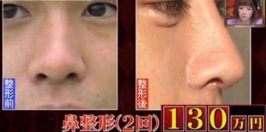 How much is japan's eyelid cut
