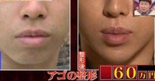 How much is japan's eyelid cut