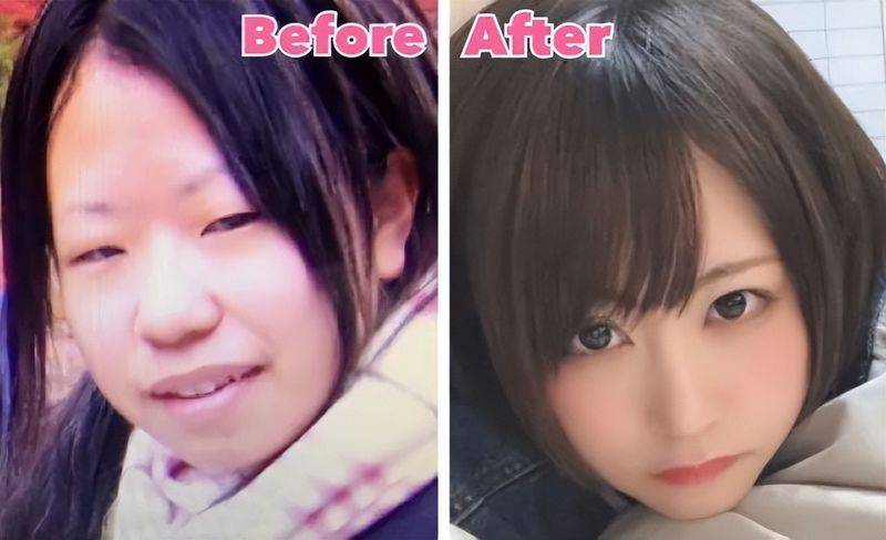 日本割双眼皮多少钱