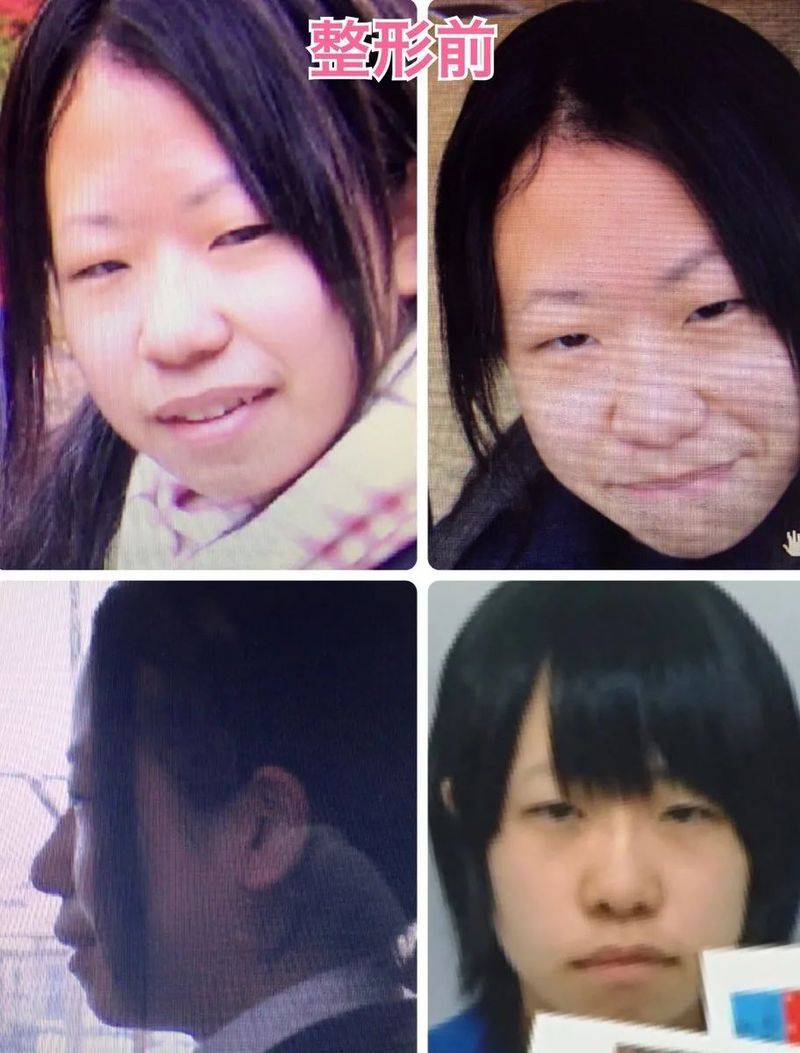 日本割双眼皮多少钱