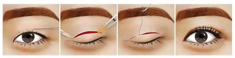 How much is japan's eyelid cut