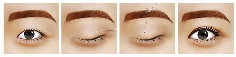 How much is japan's eyelid cut