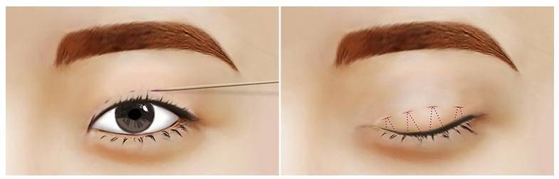 How much is japan's eyelid cut